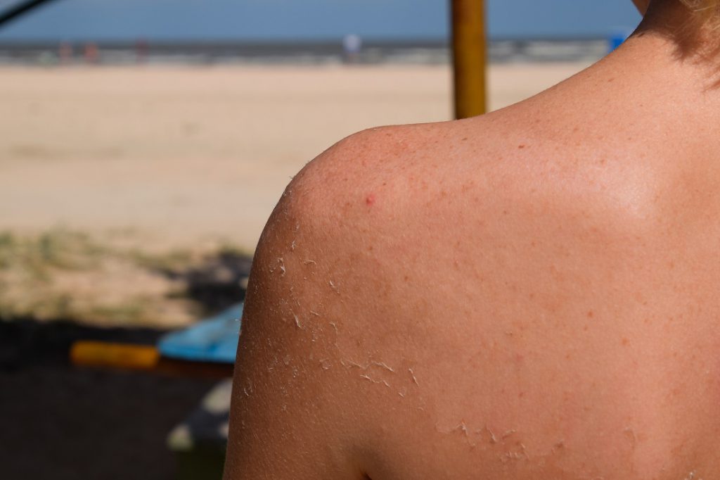 Sunburn_Peeling-1024x682.jpg